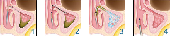 Balloon Sinuplasty