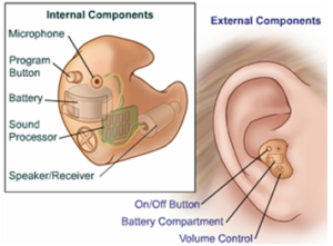 Parts of a Hearing Aid