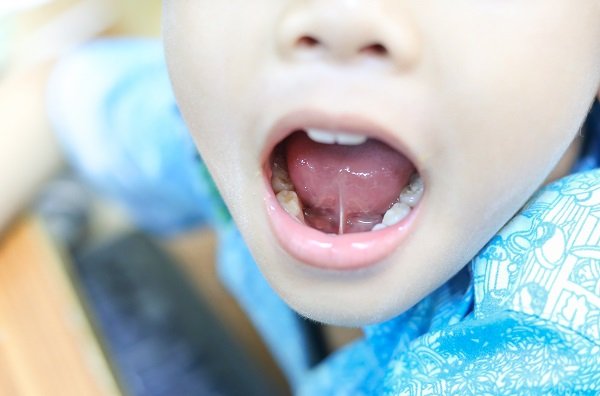 lingual frenulum cut