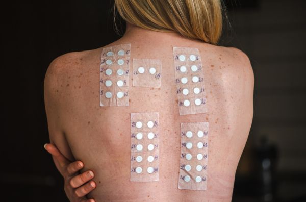 Patch Testing: A Reliable Way to Diagnose Skin Allergies